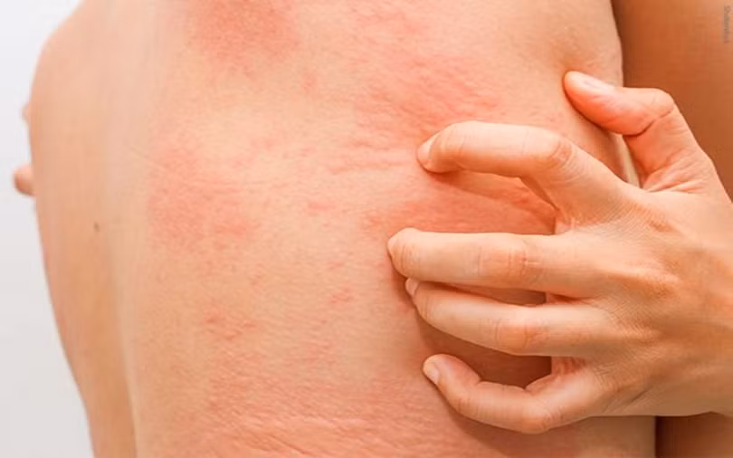 9 bệnh da liễu nguy hiểm ở trẻ