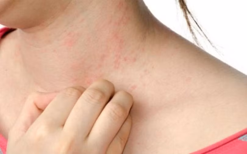 9 bệnh da liễu nguy hiểm ở trẻ