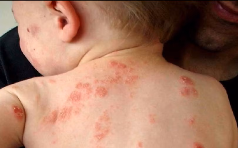 9 bệnh da liễu nguy hiểm ở trẻ