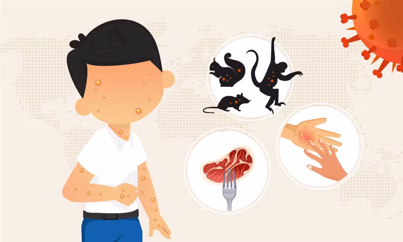 Điều trị đậu mùa khỉ thế nào