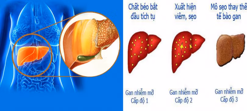 Gan nhiễm mỡ: Nhận biết dấu hiệu, nguyên nhân và điều trị sớm để ngừa xơ gan