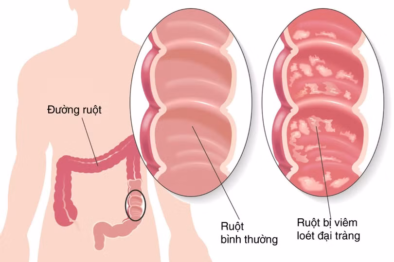 Khi mắc viêm đại tràng mạn tính không được điều trị đúng có thể dẫn đến biến chứng.