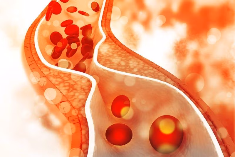 Cholesterol cao có thể gây xơ vữa động mạch, dẫn đến nhồi máu cơ tim và đột quỵ.