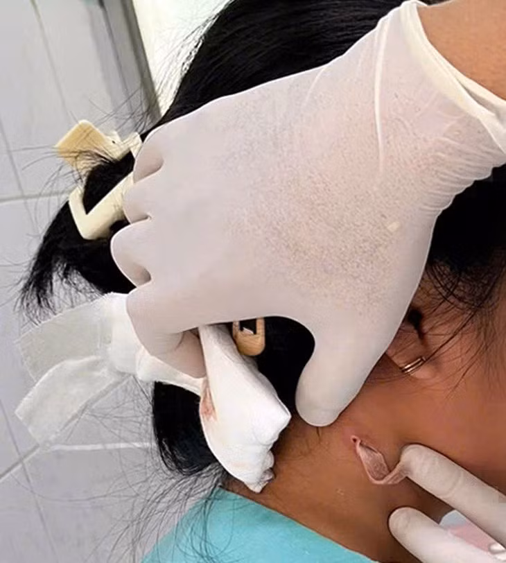 Bé gái 14 tuổi nhiễm vi khuẩn ăn thịt người đang được điều trị tại Bệnh viện Nhi đồng Đồng Nai - Ảnh: Bệnh viện cung cấp