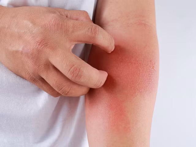 Dị ứng thời tiết xuất hiện quanh năm, đặc biệt là thời điểm giao mùa.