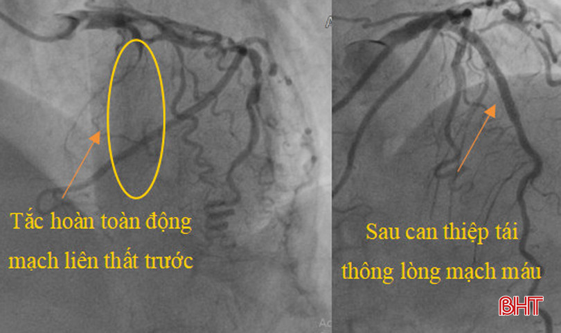 Hiệu quả so sánh trong việc triển khai can thiệp tim mạch đối với các bệnh nhân bị nhồi máu cơ tim cấp. mach vanhA.jpg