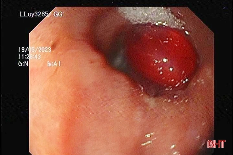 Uống thuốc quên bóc vỉ, một bệnh nhân nhập viện