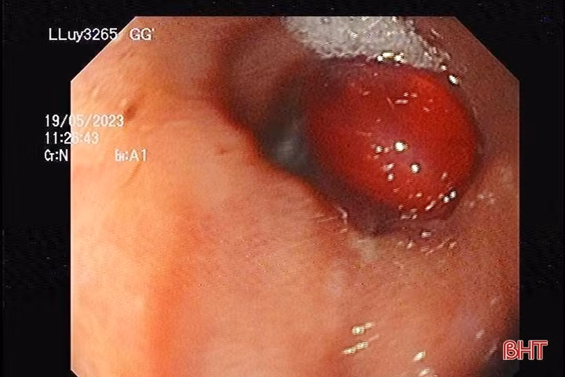 Uống thuốc quên bóc vỉ, một bệnh nhân nhập viện