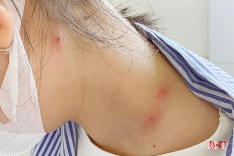 Bác sỹ Hà Tĩnh khuyến cáo về các biến chứng của bệnh thủy đậu