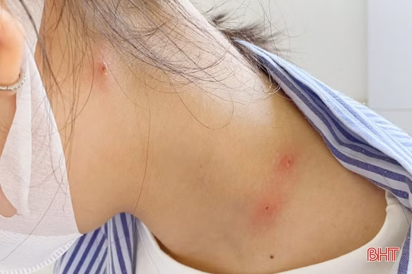 Bác sỹ Hà Tĩnh khuyến cáo về các biến chứng của bệnh thủy đậu