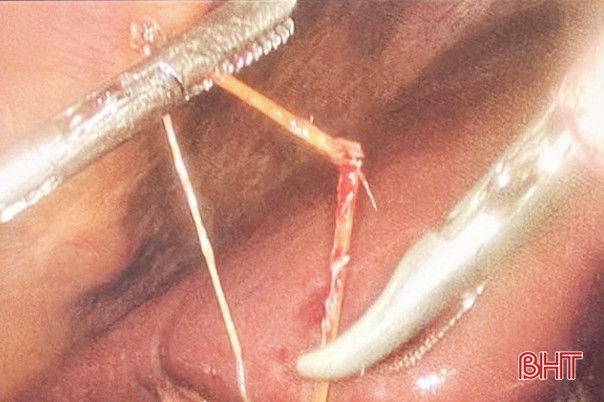 Mổ lấy tăm tre xuyên thủng đường tiêu hóa bệnh nhân 68 tuổi ở Hà Tĩnh