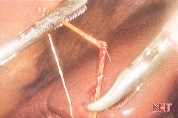 Mổ lấy tăm tre xuyên thủng đường tiêu hóa bệnh nhân 68 tuổi ở Hà Tĩnh