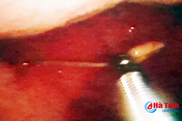 suyt thung da day vi nuot phai chiec tam tre sau khi an com