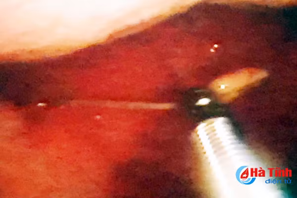 suyt thung da day vi nuot phai chiec tam tre sau khi an com