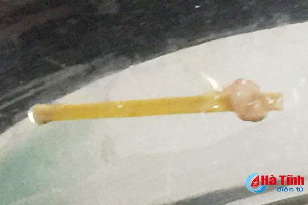 suyt thung da day vi nuot phai chiec tam tre sau khi an com