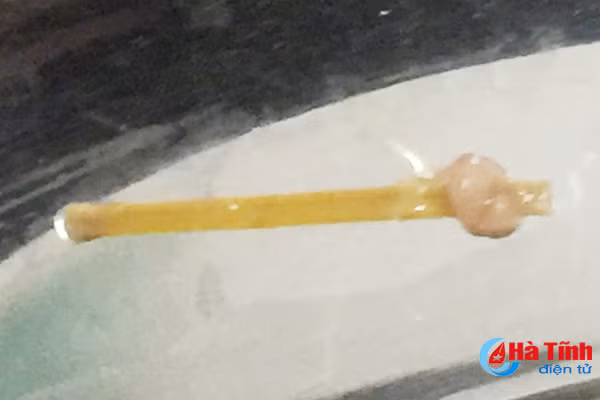 suyt thung da day vi nuot phai chiec tam tre sau khi an com