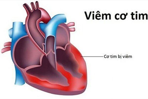 Sau tiêm vaccine phòng COVID-19 nên tập luyện như thế nào để có lợi cho sức khỏe?