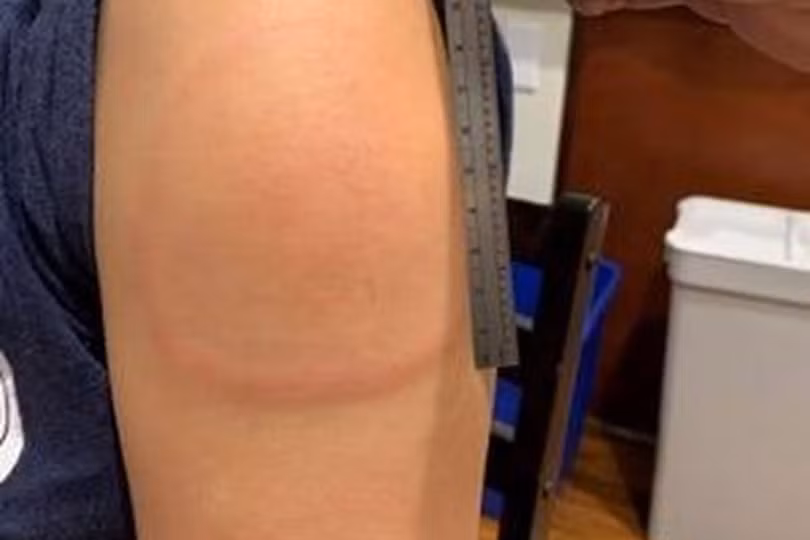 Cách giảm rủi ro phản ứng sau tiêm vaccine COVID-19