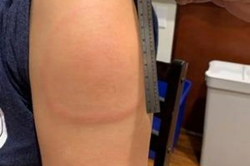 Cách giảm rủi ro phản ứng sau tiêm vaccine COVID-19