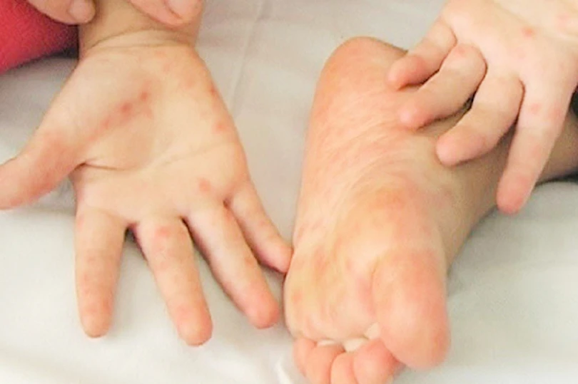 Hà Tĩnh chỉ đạo khẩn về phòng, chống và điều trị bệnh tay chân miệng