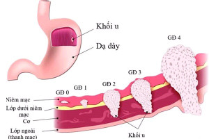 Các loại ung thư khó phát hiện sớm