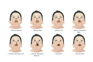 Cơ hội cho trẻ em Hà Tĩnh bị dị tật sứt môi, hở hàm ếch được phẫu thuật miễn phí