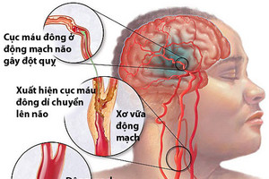 Phòng ngừa đột quỵ não khi trời lạnh giá