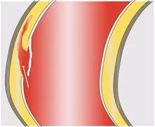 Bệnh lý động mạch chủ - nguy cơ tử vong cao