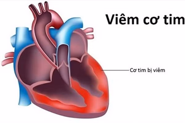 Bộ Y tế hướng dẫn chẩn đoán, điều trị viêm cơ tim sau tiêm vắc xin COVID-19