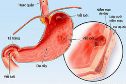 Cảnh báo bệnh dạ dày ở trẻ em đang gia tăng