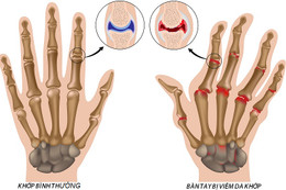 Sống chung với viêm khớp dạng thấp thế nào?