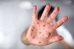 Nguy cơ lây lan dịch tay chân miệng với chủng virus gây tỷ lệ tử vong cao