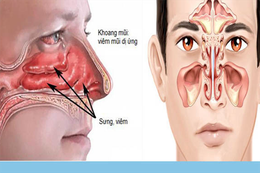 Cách phân biệt viêm xoang và viêm mũi dị ứng