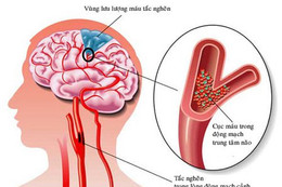 Chất chuyển hóa có liên quan đến nguy cơ đột quỵ