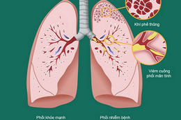 Tìm ra căn nguyên gây bệnh viêm đường hô hấp mạn tính