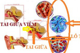 Trẻ bị viêm tai giữa - chăm sóc như thế nào?