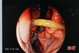 Ngậm tăm lúc ngủ, người đàn ông 60 tuổi ở Hà Tĩnh bị thủng dạ dày