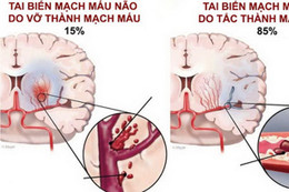 Tai biến mạch máu não: Cấp cứu thế nào để tránh tử vong?