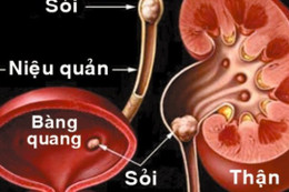 Nhớ uống nhiều nước ngừa sỏi thận