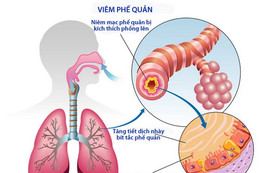 Phòng ngừa bệnh đường hô hấp dễ mắc trong mùa nóng