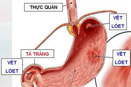 Bài thuốc trị viêm loét dạ dày - tá tràng