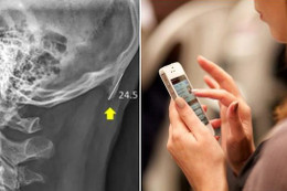Người trẻ đang bị "mọc sừng" do dùng smartphone quá nhiều