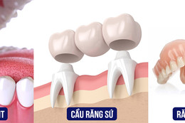 Cơ hội “vàng” cho người dân Hà Tĩnh trồng răng Implant tại Bệnh viện Thái Thượng Hoàng – TP. Vinh