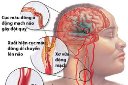 Phòng ngừa đột quỵ não khi trời lạnh giá