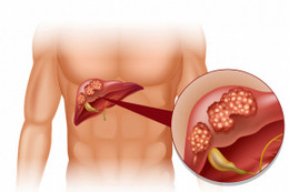 Cách phát hiện ung thư gan nhanh nhất