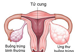 Ung thư buồng trứng không quá đáng sợ?