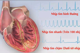 Những hệ lụy khi bị rối loạn nhịp tim