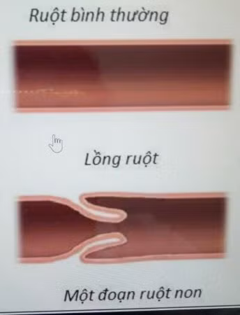 4 dấu hiệu chứng tỏ trẻ bị lồng ruột, cha mẹ cần lưu ý