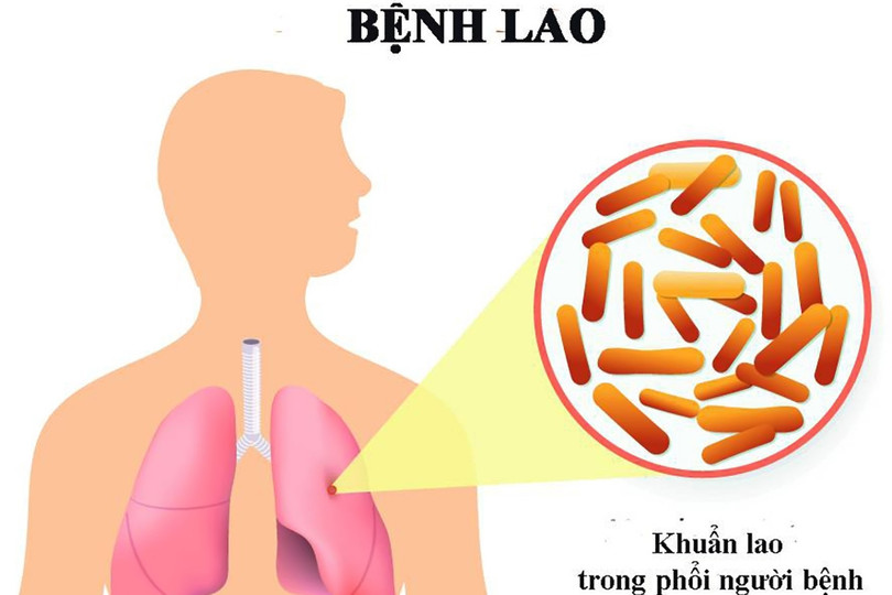 Các bệnh dễ nhầm với lao phổi Các bệnh dễ nhầm với lao phổi