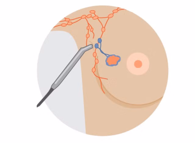 Những yếu tố tăng nguy cơ mắc ung thư vú